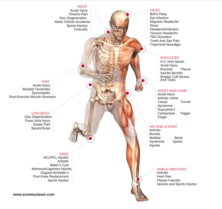 Body diagram of conditions treatable with laser therapy, from head and neck to ankle and foot